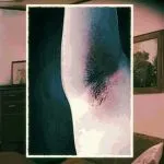 Irritated armpits for wheelchair man